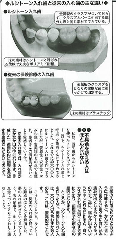 ノンクラスプデンチャー記事２