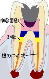 3Mix法　治療後