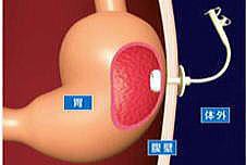 胃ろうの仕組み