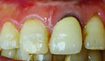 健康保険適応のプラスチックのさし歯