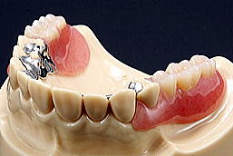金属床義歯とエステショットの組み合わせ（装着時）