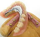 インプラント義歯（ロケーター義歯）