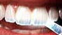 前歯の酸蝕歯