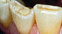 前歯の酸蝕歯