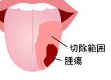 舌半側切除術