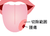 舌部分切除術